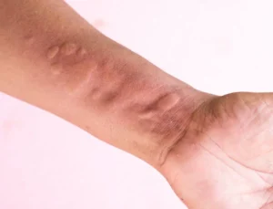 Yes, I would add **skin symptoms**, but with an important distinction: airborne exposure can cause skin symptoms in some sensitised people, particularly when allergen-containing dust or particles contact the skin. We can include this without making the article overly medical. I’d revise the relevant sections and incorporate the stronger points from the source. [Austin Allergist — Airborne Food Allergens](https://www.austinallergist.com/navigating-airborne-food-allergens-risks-reactions-and-precautions/?utm_source=chatgpt.com) We often associate food allergies with eating a trigger food. However, some food proteins can become airborne during cooking, processing or handling. Sensitive people may inhale these proteins and develop respiratory symptoms, even without consuming the food. Airborne exposure can also affect the skin when allergen-containing particles come into contact with it. This type of exposure matters particularly in food workplaces, where employees may regularly handle allergenic ingredients. Flour dust and airborne proteins released during seafood processing are common examples. Understanding these exposures can help food businesses identify risks, improve workplace practices and reduce the chances of allergic reactions. #### **What Are Airborne Food Allergens?** Airborne food allergens are food proteins that become suspended in the air and enter the body through inhalation or contact with the skin. Pouring powdered ingredients can create fine dust, while grinding, mixing and processing can release particles or aerosols. Some cooking methods can also disperse food proteins. An airborne allergen does not automatically cause a reaction. Risk depends on the allergen, the amount and form of exposure, and individual sensitivity. #### **How Do Food Allergens Become Airborne?** Food form and handling determine whether it can become airborne. Dry ingredients provide a clear example. Pouring flour, transferring powdered ingredients or adding them to a mixer can release fine particles. Grinding and milling can generate more dust. Cooking can also release food proteins into the air. For example, steaming, boiling or frying fish and shellfish may disperse allergenic proteins, particularly in enclosed spaces. Cutting, mixing, spraying and some cleaning processes may also disperse food proteins. Large-scale processing can increase exposure. #### **Flour Dust: A Familiar Example** Flour dust is a well-known example of occupational food-allergen exposure. Bakers, millers and other employees may inhale flour particles while weighing, pouring, sieving or mixing. Wheat proteins can trigger reactions, and some baking enzymes can also contribute to sensitisation. Repeated exposure can cause occupational respiratory problems, including rhinitis and asthma, in some workers. Flour particles can also settle on the skin and cause irritation or allergic skin symptoms in sensitive individuals. Pouring flour quickly, dropping bags or disturbing settled flour can create dust clouds. Careful handling can reduce exposure. #### **What Other Foods Can Become Airborne?** Flour is not the only ingredient that can create airborne exposure. Workers in seafood-processing facilities may encounter fish or shellfish proteins in the air, particularly during processes that generate droplets or aerosols. Workers may also encounter airborne proteins from eggs, grains, spices and other ingredients when handling powders or carrying out dust-generating processes. Risk varies between workplaces and depends on the food, the process and the level of exposure. #### **What Symptoms Can Exposure Cause?** When sensitive individuals encounter airborne food proteins, they may develop symptoms involving the skin, nose, eyes or respiratory system. These may include: * Sneezing * Runny or blocked nose * Watery or irritated eyes * Coughing * Wheezing * Chest tightness * Breathing difficulty * Itchy skin or skin rashes Symptoms that repeatedly appear during work and improve away from the workplace may indicate an occupational exposure. Workers with recurring symptoms should seek appropriate medical advice. #### **Is Inhaling an Allergen the Same as Eating It?** No. The exposure route matters. Food allergy commonly involves a reaction after eating a trigger food. Inhalation is a different route of exposure and can cause respiratory symptoms in some sensitised people. Contact with allergen-containing particles may also cause skin symptoms in some individuals. Being near a food does not automatically mean that a person will react. The likelihood of a reaction depends on the allergen, the amount and form of exposure, and individual sensitivity. #### **Who May Face Greater Exposure?** Airborne food allergens can particularly concern people who handle ingredients regularly at work. They may include: * Bakers and pastry workers * Flour-mill workers * Grain handlers * Food-processing workers * Seafood-processing workers * Restaurant and kitchen workers * Employees handling powdered ingredients These workers may encounter the same ingredients repeatedly. Businesses should identify tasks that generate airborne particles and control exposure. #### **How Can Food Businesses Reduce Exposure?** Food businesses can reduce airborne exposure by controlling ingredient handling, ventilation and cleaning. **Handle powdered ingredients carefully.** Pour flour and other dusty ingredients slowly instead of dropping them into containers or mixers. **Improve ventilation.** General ventilation and local exhaust systems can help remove airborne dust near where it forms. Where possible, businesses should control exposure close to its source. **Clean without disturbing settled dust.** Dry sweeping and compressed air can send particles back into the air. Wet cleaning or suitable industrial vacuum systems can help control dust. **Train employees.** Workers should understand which tasks create airborne particles and learn safer handling methods. #### **What About the Home Kitchen?** For most people, everyday food preparation does not make airborne allergens a constant concern. People with known food allergies should follow precautions recommended for their allergy, especially when handling powdered ingredients or generating considerable dust. Professional kitchens and processing facilities face greater exposure because employees may handle large quantities for hours each day. Ventilation, cleaning and worker training are particularly important. #### **The Takeaway** Food allergens do not always remain on the plate. Under certain conditions, food proteins can become airborne during handling, cooking or processing. For most consumers, this is unlikely to create an everyday risk. However, repeated exposure can affect workers who regularly handle flour, grains, seafood, eggs or other allergenic ingredients. Exposure may cause respiratory or, in some cases, skin symptoms in sensitive individuals. By identifying tasks that release food proteins into the air and controlling exposure at the source, food businesses can create safer working environments. Workers can also benefit from recognising recurring symptoms and seeking advice when they notice a possible connection with their workplace. I think this version is **more complete** because it now covers the three relevant exposure routes: **inhalation, skin contact and food consumption**, while keeping the article firmly focused on airborne allergens and food-safety/workplace exposure. 